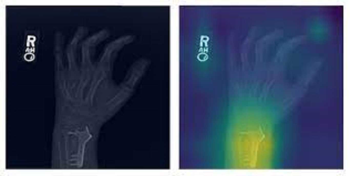 Abnormality detection in bone X-Rays